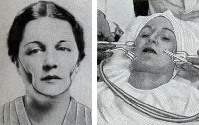 1930sduo Isabella Gilbert's Dimple Machine from 1936 and a 1932 Suction Treatment for skin-cleaning. Via ModernMechanix.com.