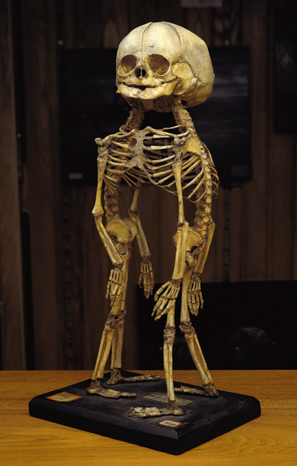 morbid_mutter A skeleton of conjoined twins at the Mütter Museum in Philadelphia. (Via Morbid Anatomy)