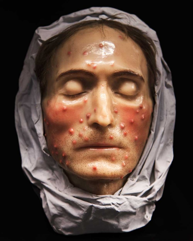 A wax head showing diseases of the skin, similar to those seen in Europe's popular museums. Courtesy Museo de la Medicina Mexicana, Mexico City. Photo © Joanna Ebenstein.